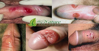 Obat Alami Sakit Sipilis