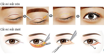 Kết quả sau phẫu thuật cắt mí mắt tồn tại lâu không? 2