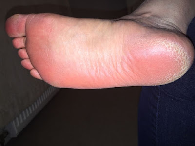 Feet before treatment