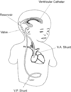 shunt aurelia