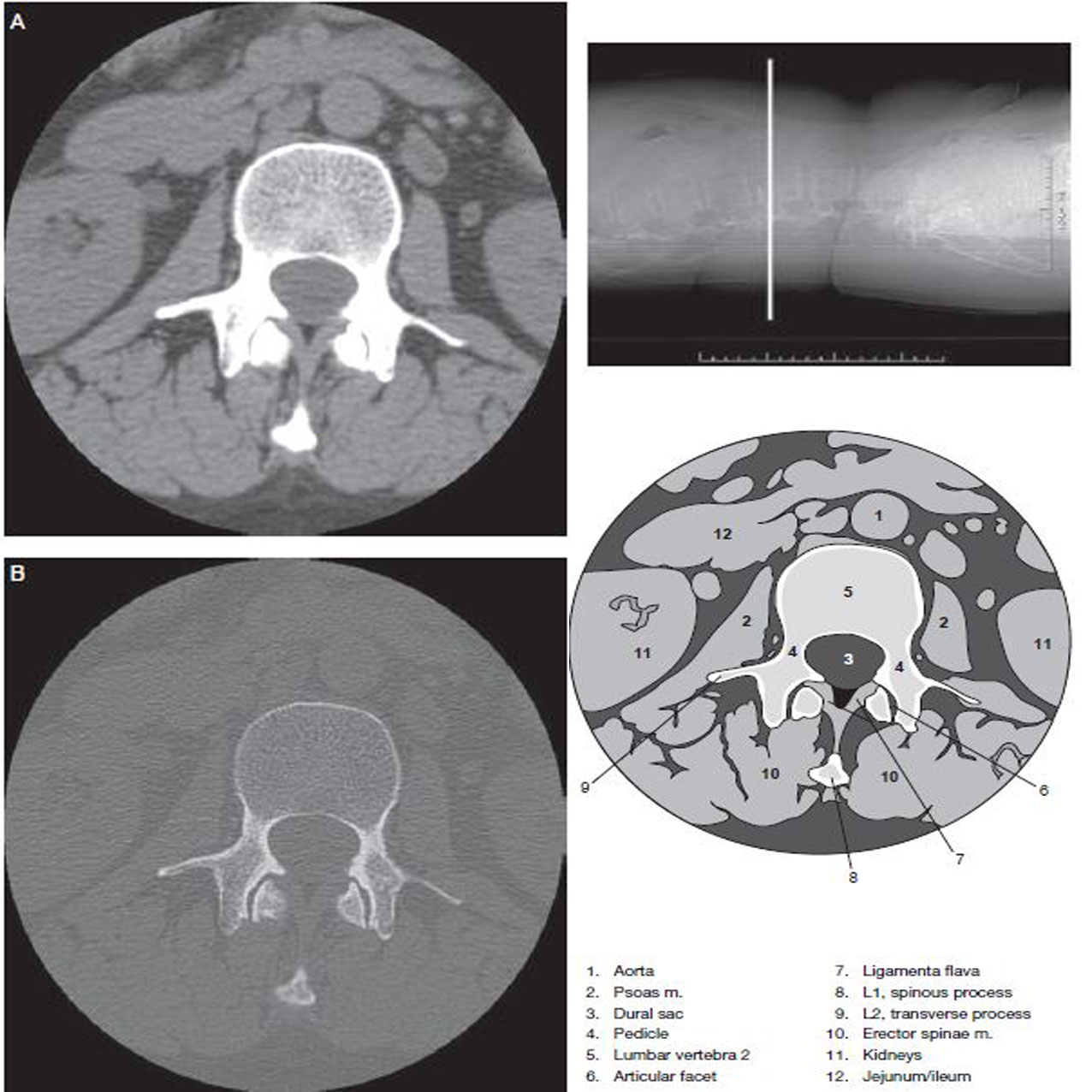 Lumbar Spine - Ct Scan - RadTechOnDuty