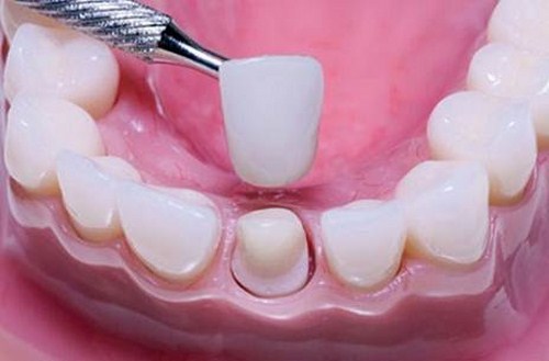 KHÔNG MÀI RĂNG CÓ BỌC SỨ ĐƯỢC KHÔNG -3