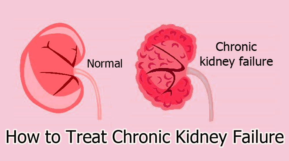 How to Treat Chronic Kidney Failure