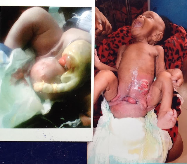 A baby delivered through the anus Michael churchills dick