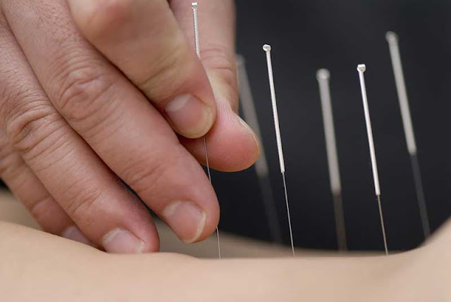 Acupuncture Found To Be A Potential Adjunct Therapy For Type 2 Diabetes Acupuncture Found To Be A Potential Adjunct Therapy For Type 2 Diabetes