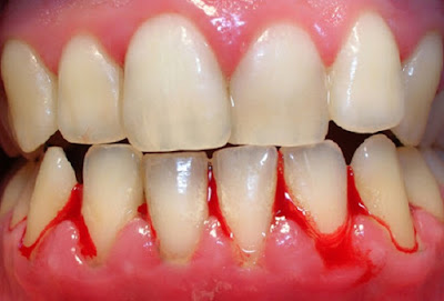 tự nhiên chảy máu chân răng tự nhiên chảy máu chân răng
