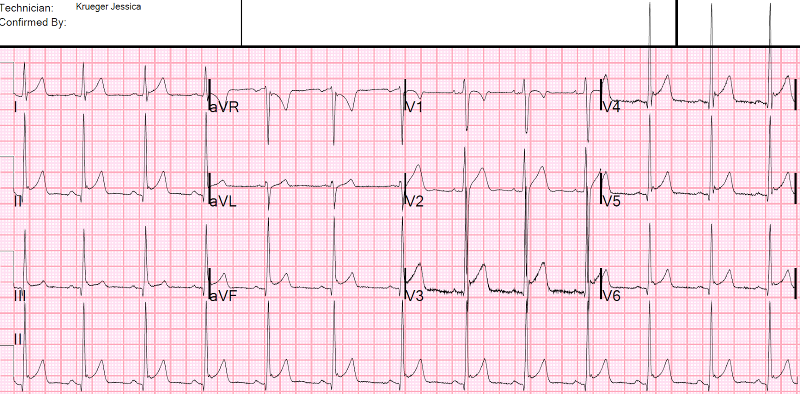 Dr. Smith's ECG Blog A Young Man with Sharp Chest pain