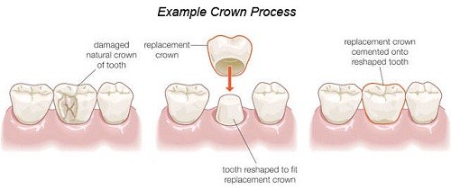 BÀ BẦU CÓ LÀM RĂNG SỨ ĐƯỢC KHÔNG -4