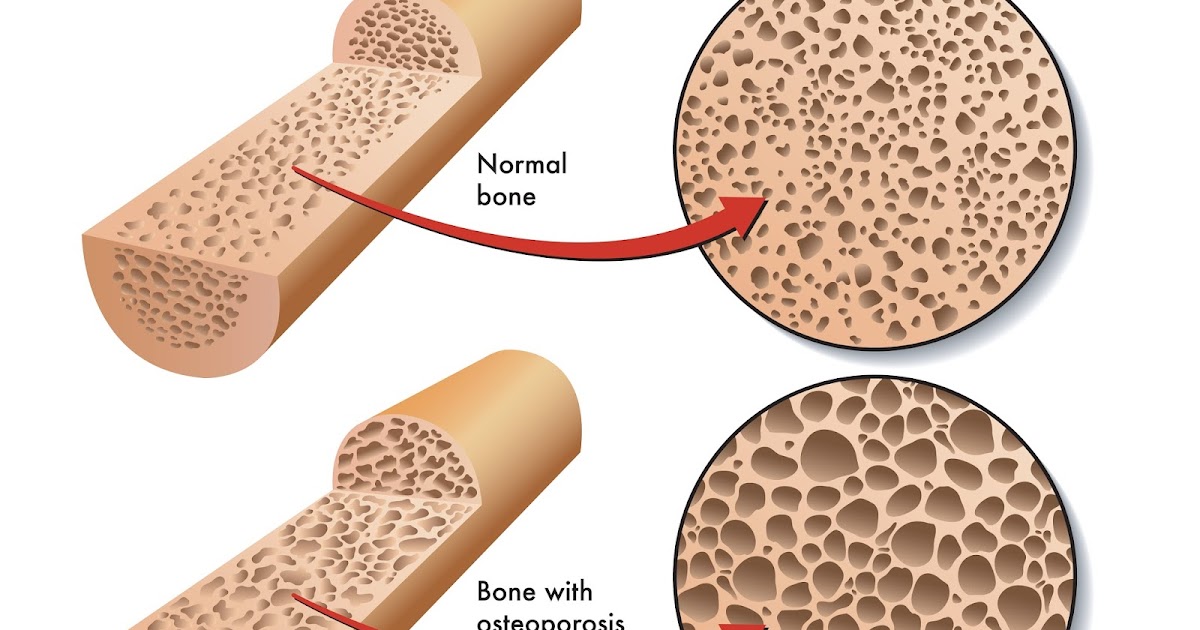 Tymlos/Abaloparatide Cost, Side effects, Dosage, Uses for