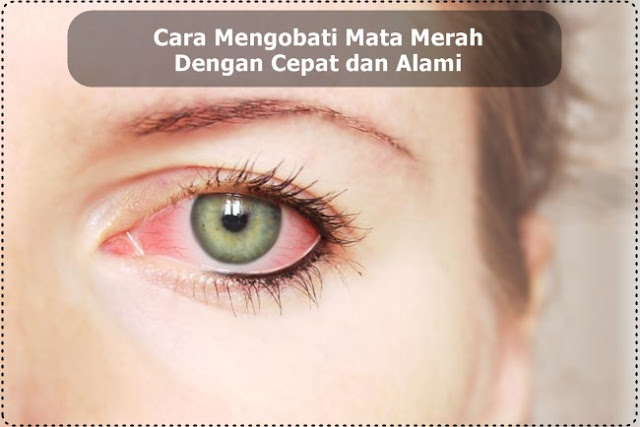 Cara Mengobati Mata Merah Dengan Cepat dan Alami | Spesialis Obat Herbal