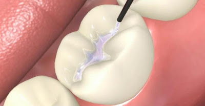 Trám răng thẩm mỹ có bền không còn dựa vào chất lượng của chất trám