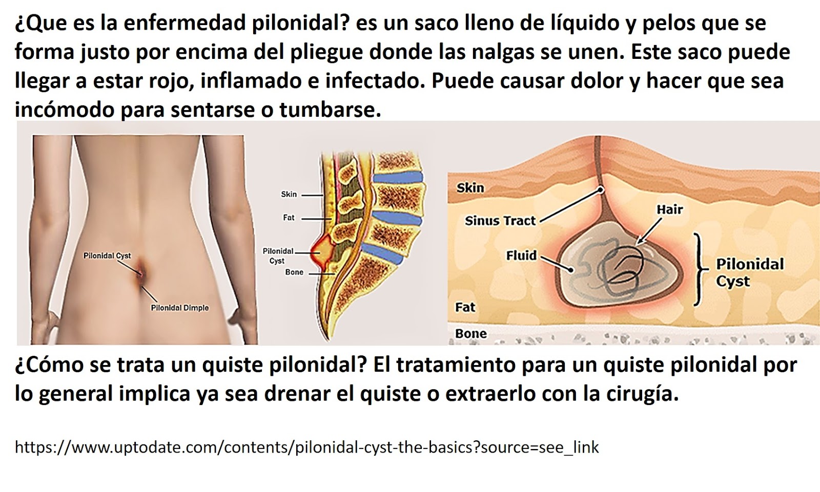 por que tengo quiste pilonidal