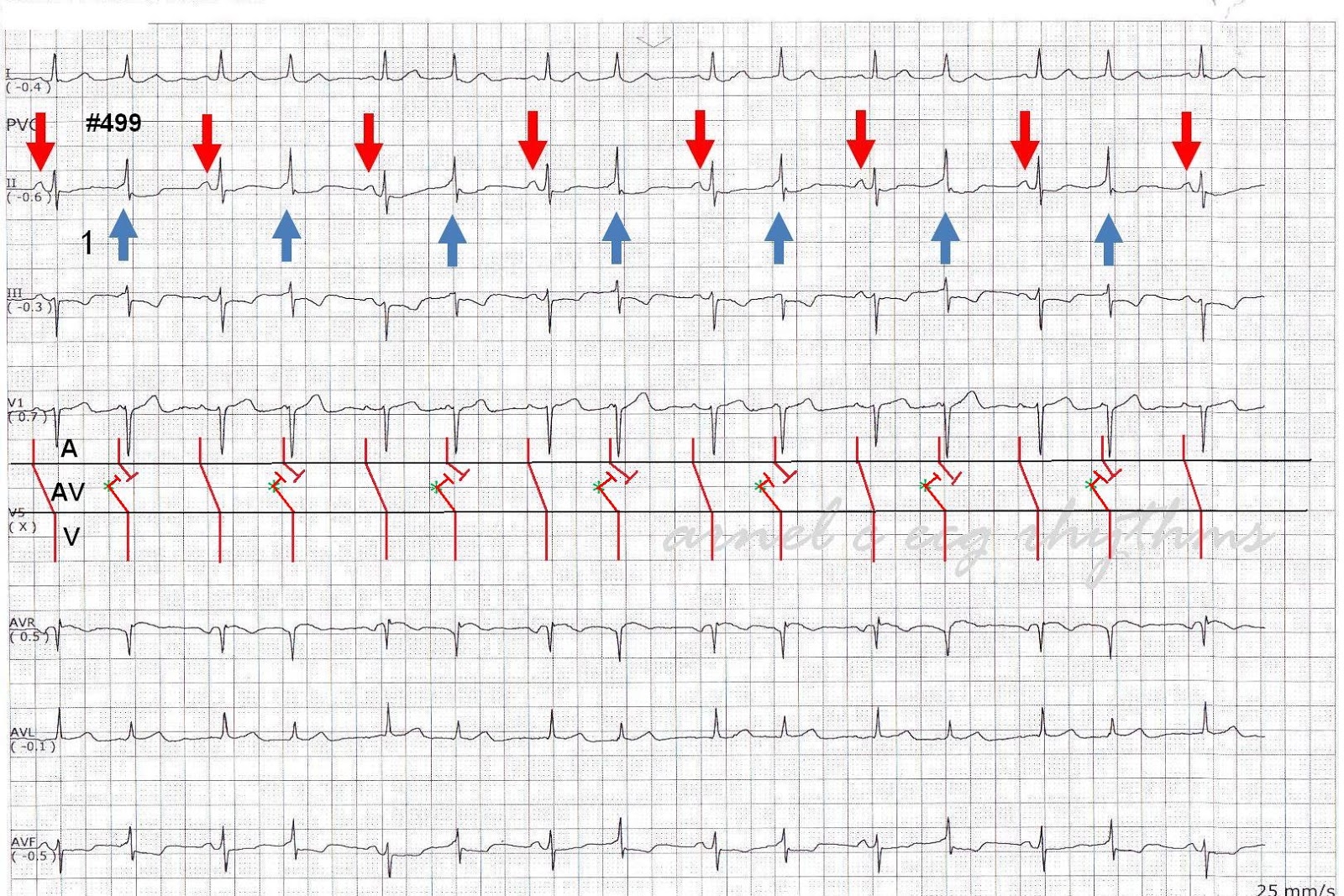 ECG Channel AV dissociation