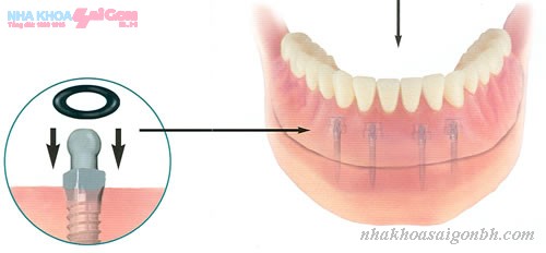 Giai phap trong rang cua bang cay ghep implant