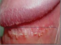 Jual Obat Kutil Kelamin Di Aceh