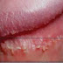 Makalah Askep Kondiloma thumbnail