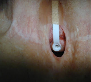 voice prothesis voice prothesis
