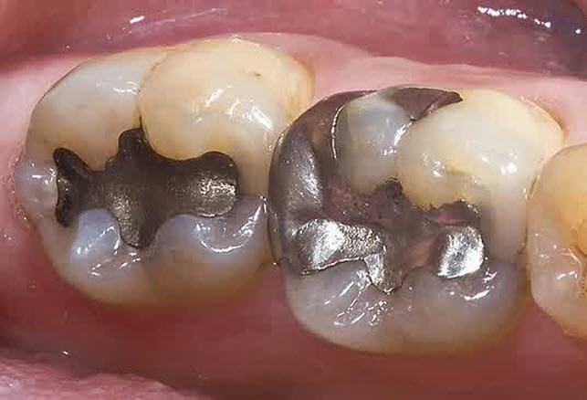 GIGI KAMU BERLUBANG? JANGAN DITAMBAL ATAU DICABUT NANTI KAMU AKAN