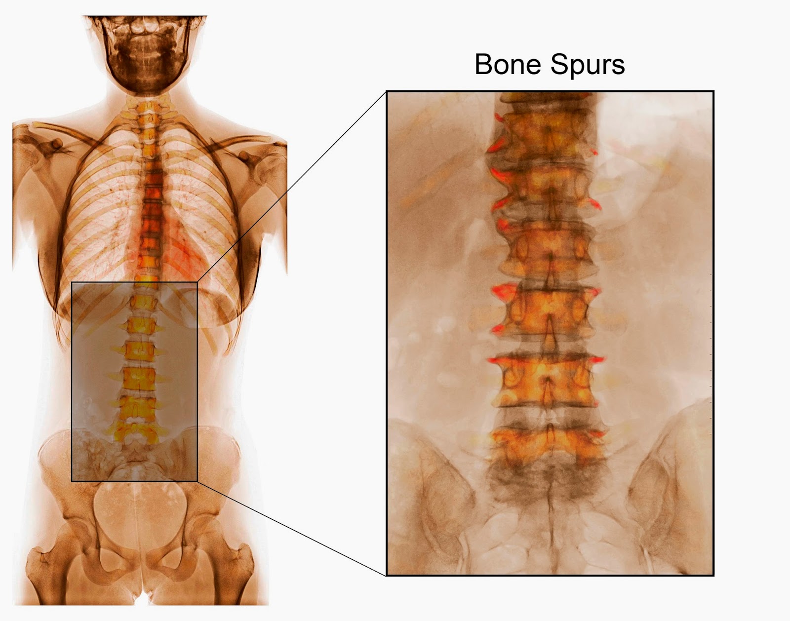 Disc Disease Degenerative Disc Disease Bone Spurs