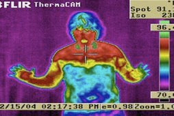 Thermal image showing autonomic dysfunction following ETS surgery