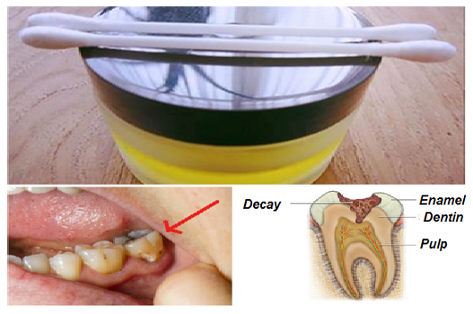 Tooth Pain Disappears In A Second This Is The Best Natural Remedy For Toothache Morelk Com
