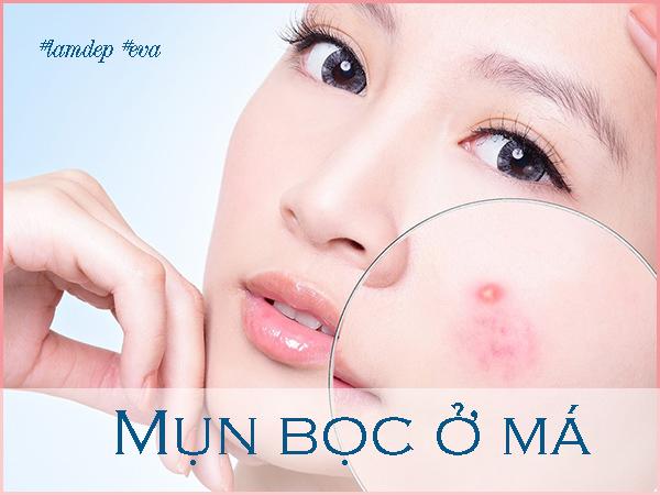 Làm theo cách này hằng ngày đánh bay mụn bọc Làm theo cách này hằng ngày đánh bay mụn bọc