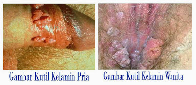 Kutil Kelamin Kutil Kelamin