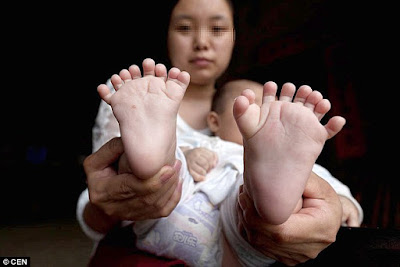 Orang Tua Putus Asa Memohon Bantuan Setelah Anak Mereka Lahir Dengan 15 Jari Tangan dan 16 Jari Kaki Orang Tua Putus Asa Memohon Bantuan Setelah Anak Mereka Lahir Dengan 15 Jari Tangan dan 16 Jari Kaki