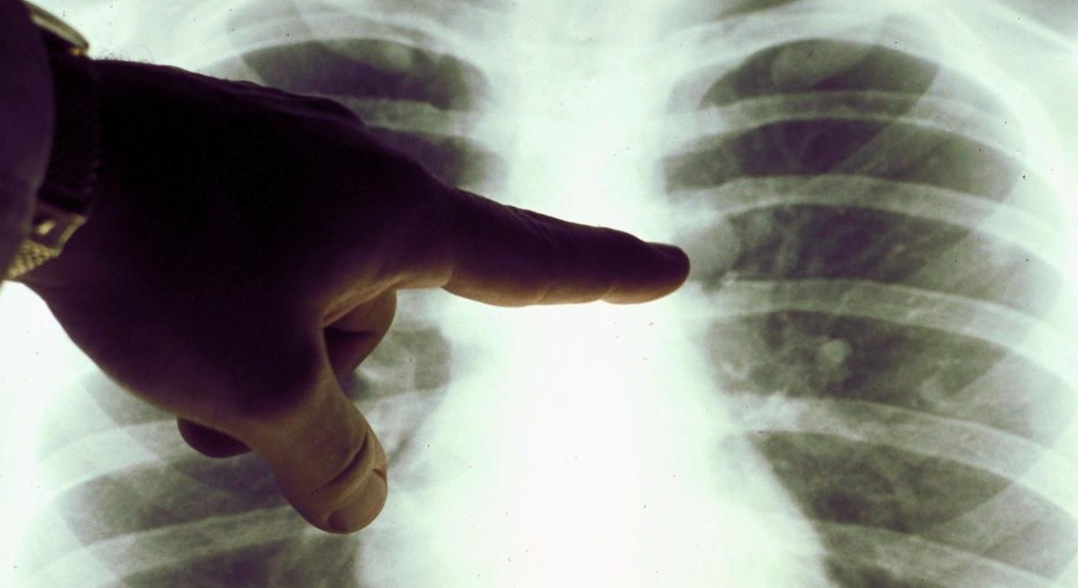 Guariti da Coronavirus ma con polmoni danneggiati.