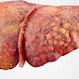 This One Plant Can Save Your Liver And Your Life