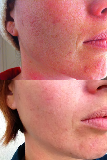my three months results with Nerium AD age dying treatment