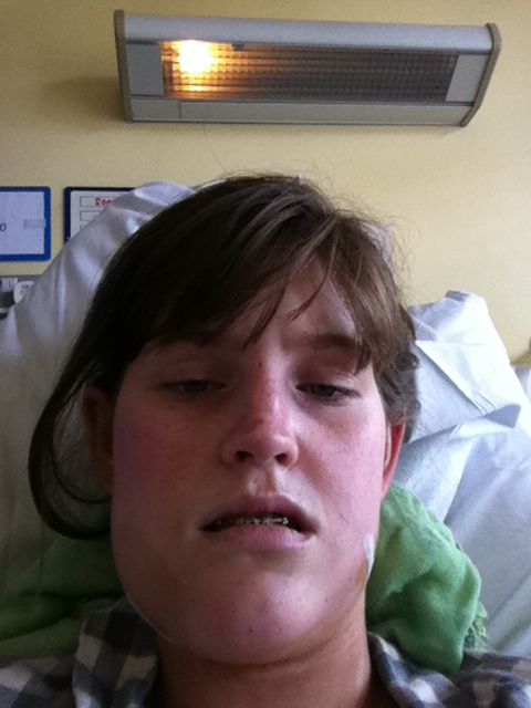 A Guide to Surviving Orthognathic Surgery: Recovering after