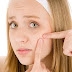 The Causes Of Cystic Acne You Should Know!