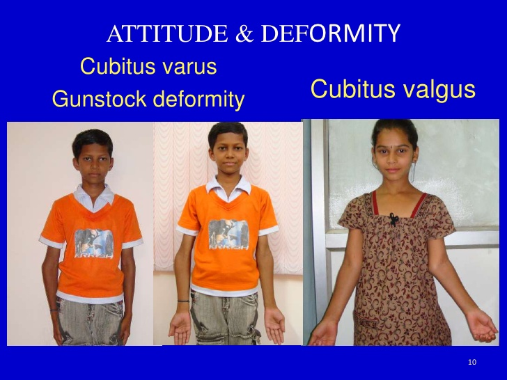 Cortex Medx (nanonotes) Supracondylar Humerus Fracture