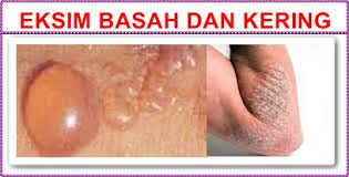 Jual Obat Gatal di Sekujur Badan Jual Obat Gatal di Sekujur Badan