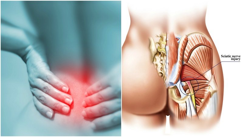 what type of doctor should i see for sciatica pain what type of doctor should i see for sciatica pain