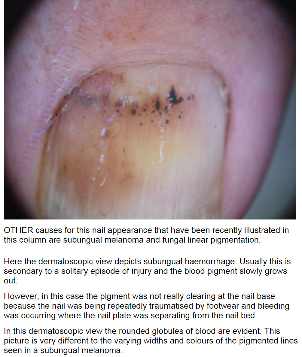 Consultations in Dermatology Subungual hematoma