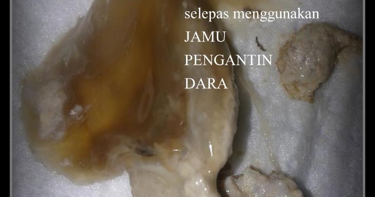 Ubat Keputihan Insert  Naskah v