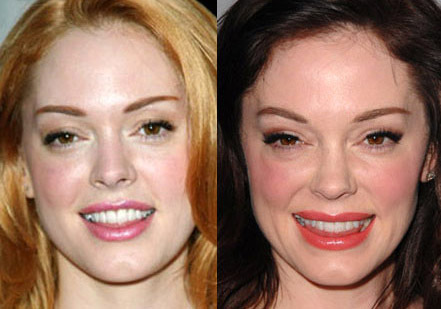 Celebrity Plastic Surgery Gone bad before and after