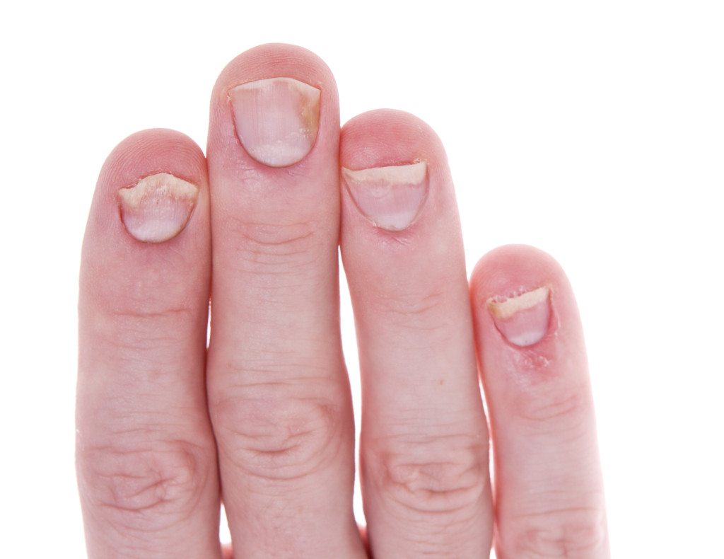 What causes pitted fingernails Awesome Nail