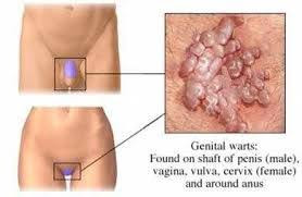 Foto OBAT PODOPHYLLOTIXIN UNTUK PENYAKIT KUTIL KELAMIN PALING ALAMI