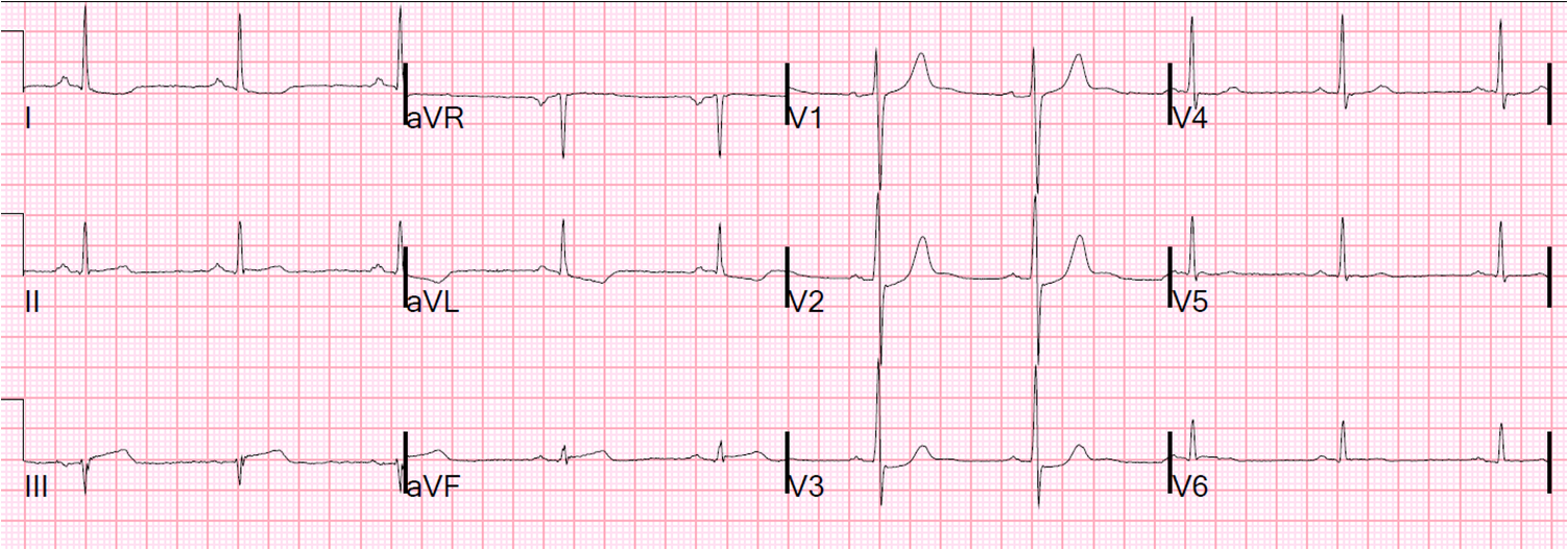 Dr. Smith's ECG Blog Waxing and Waning Chest Pain