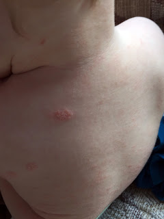 Baby Eczema Back Plaques