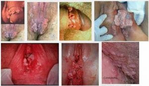 Nama Obat Kutil Kelamin Ampuh Di Apotik Paling Laris Saat Ini Nama Obat Kutil Kelamin Ampuh Di Apotik Paling Laris Saat Ini