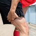 Apa itu cedera hamstring?