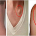 Remove Lipomas Effectively Fast With Natural Home Remedy