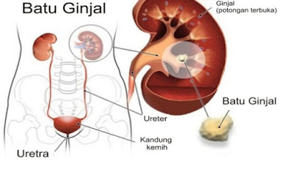 Waspada Asam Urat Yang Tinggi Waspada Asam Urat Yang Tinggi