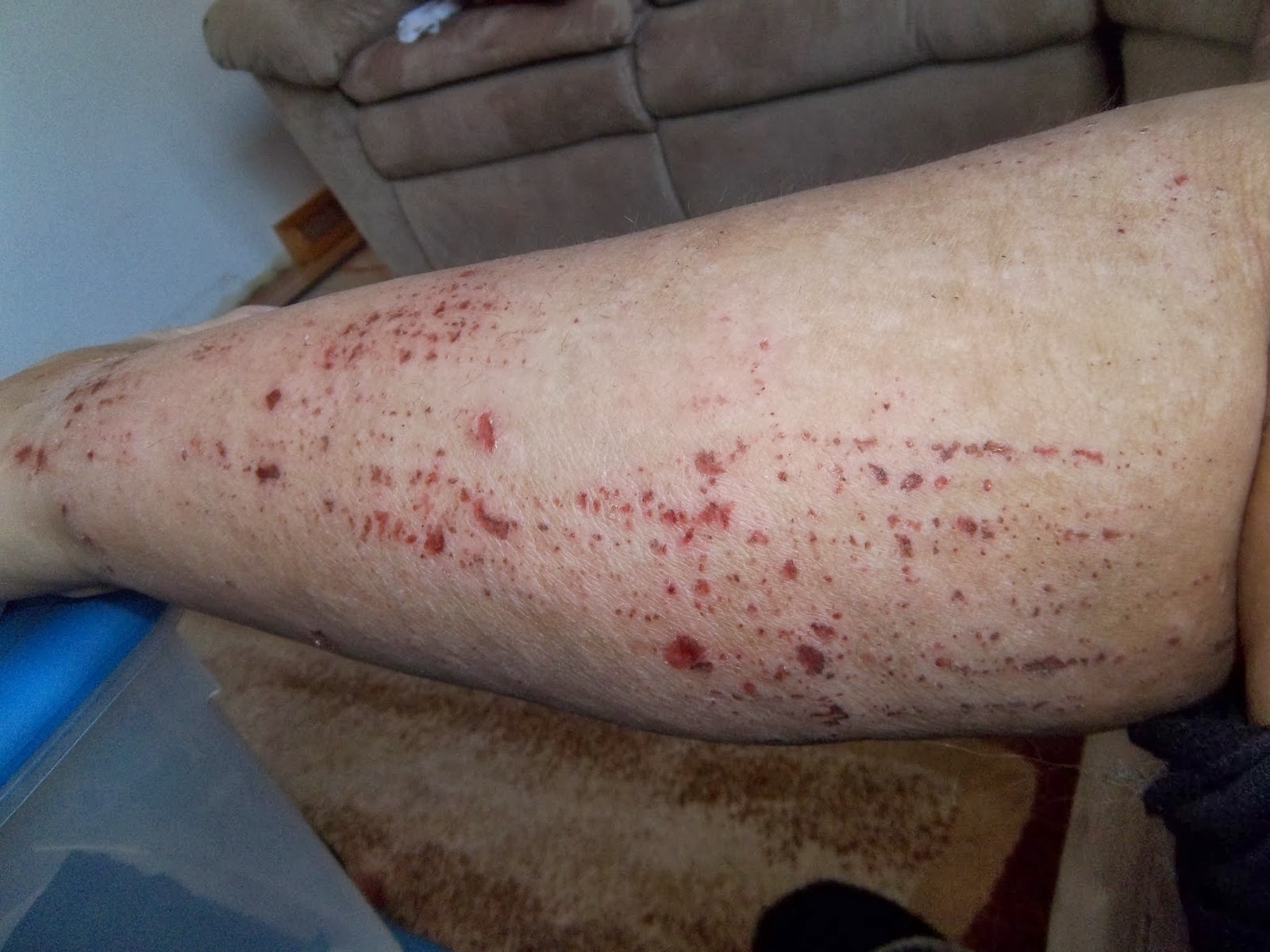 Itchy Scabs On Body - Doctor insights on HealthTap