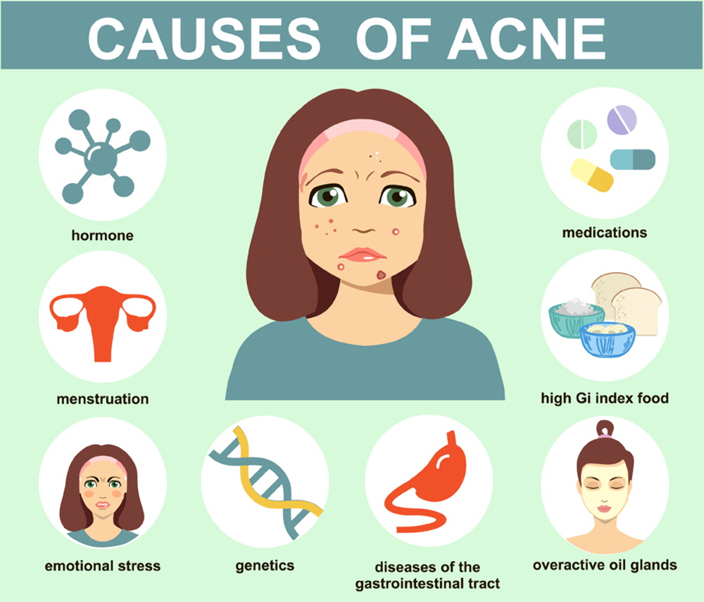 Causes of acne | Safehealthtips.com