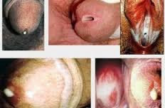 Obat Penderita Sifilis Obat Penderita Sifilis
